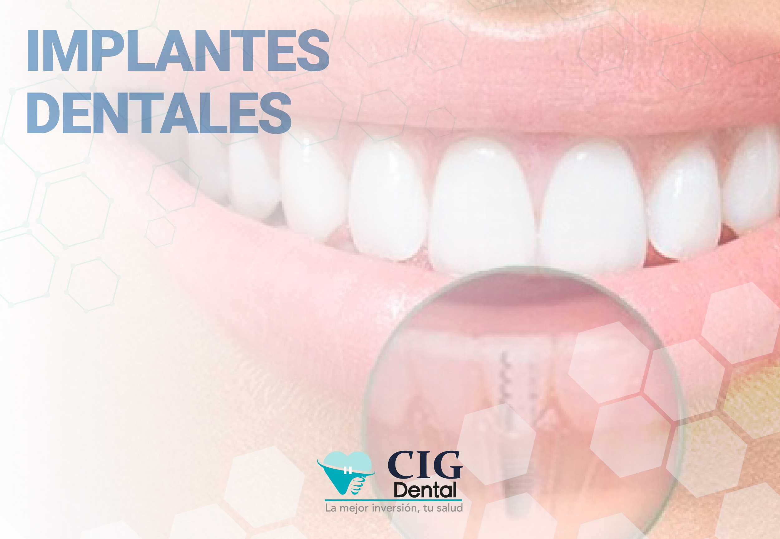 Implantes Dentales